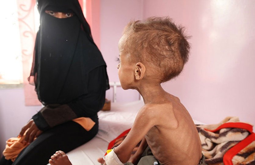 وزير الصحة اليمني يكشف عن وفاة 50 ألف رضيع سنويا بسبب انعدام الخدمات الصحية
