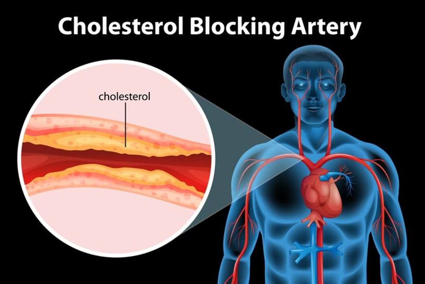 6 أعراض تدل على ارتفاع الكوليسترول في الدم
