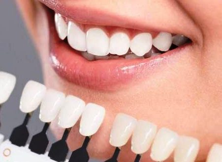 ما هي الأضرار المحتملة لمنتجات تبييض الاسنان؟