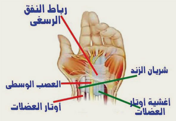 متلازمة نفق الرسغ