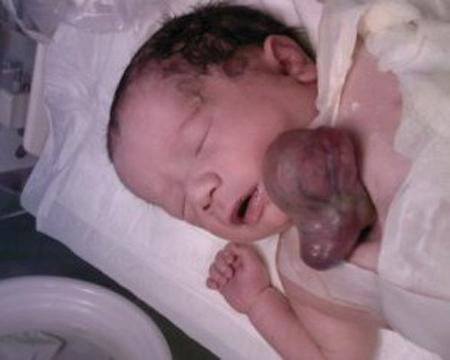 فيديو: ولادة طفلة بقلب خارج القفص الصدري