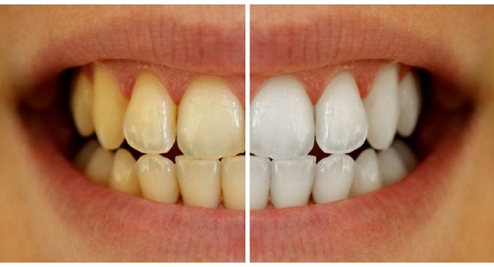 اكتشاف مادة جديدة "آمنة" لتبييض الأسنان
