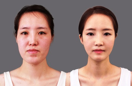 فتيات كوريا الجنوبية يقبلن على أشد الجراحات التجميلية خطورة